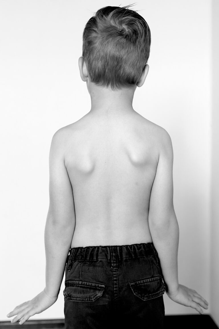 How to improve teenage posture. Lordosis, Kyphosis, Scoliosis.
